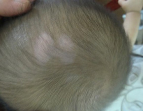 头部有白癜风患者<em>头发</em>会<em>变白</em>吗-白癜风|头部有